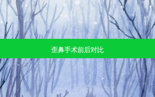 歪鼻手术前后对比