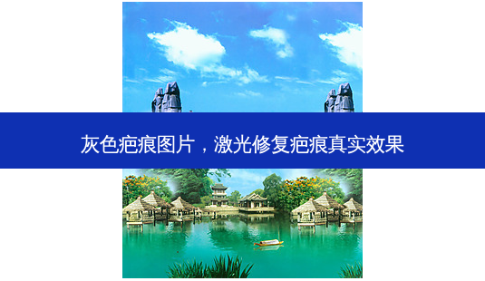灰色疤痕图片，激光修复疤痕真实效果-第1张图片-容颜讯