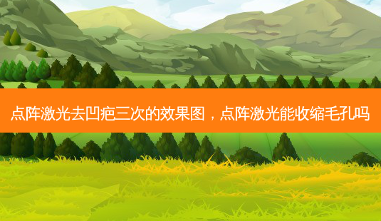 点阵激光去凹疤三次的效果图,点阵激光能收缩毛孔吗-第1张图片-容颜讯 点阵激光去凹疤三次的效果图,点阵激光能收缩毛孔吗-第1张图片-容颜讯