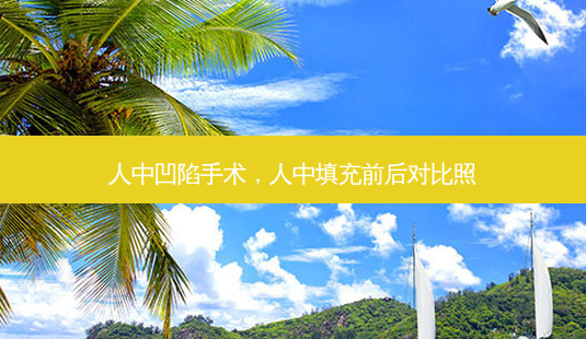 人中凹陷手术,人中填充前后对比照-第1张图片-容颜讯 人中凹陷手术,人中填充前后对比照-第1张图片-容颜讯