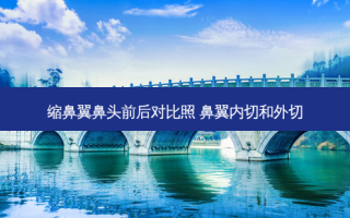 缩鼻翼鼻头前后对比照 鼻翼内切和外切