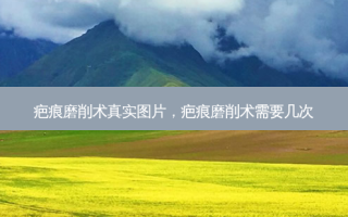 疤痕磨削术真实图片，疤痕磨削术需要几次