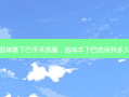 假体隆下巴手术视频，假体丰下巴能保持多久